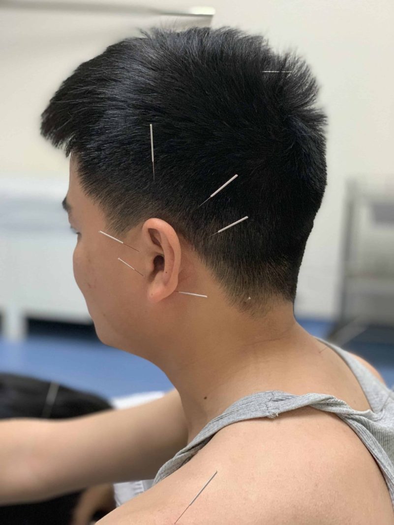 Can Acupuncture help Anxiety and Depression Acupuncture Zen Delray