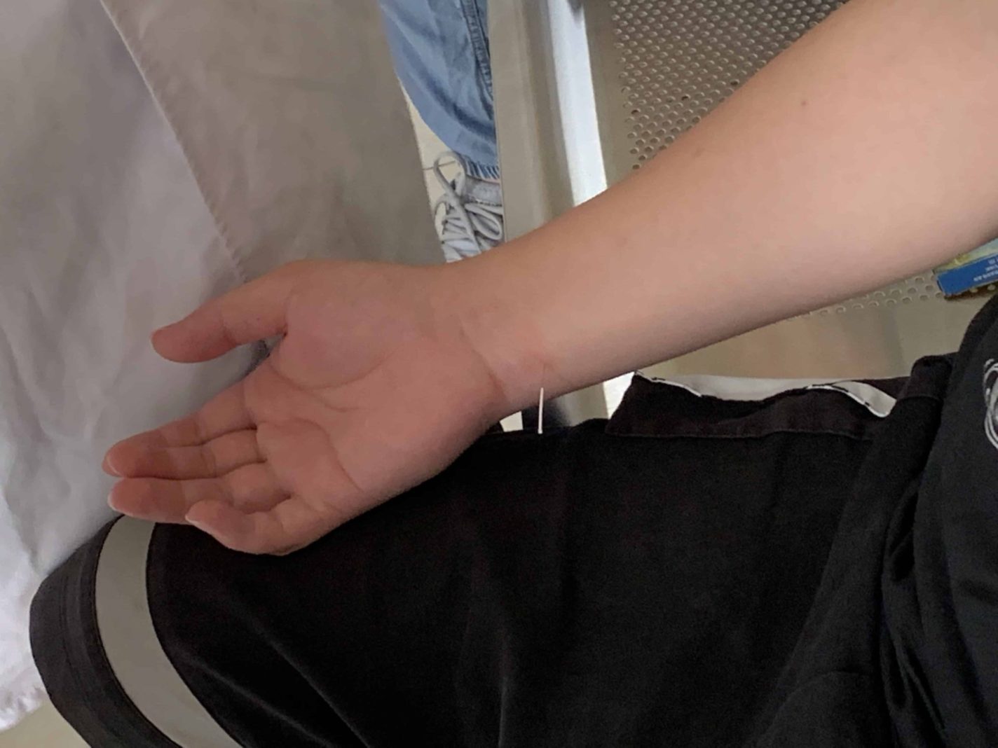 Acupuncture and Carpal Tunnel Syndrome Acupuncture Zen