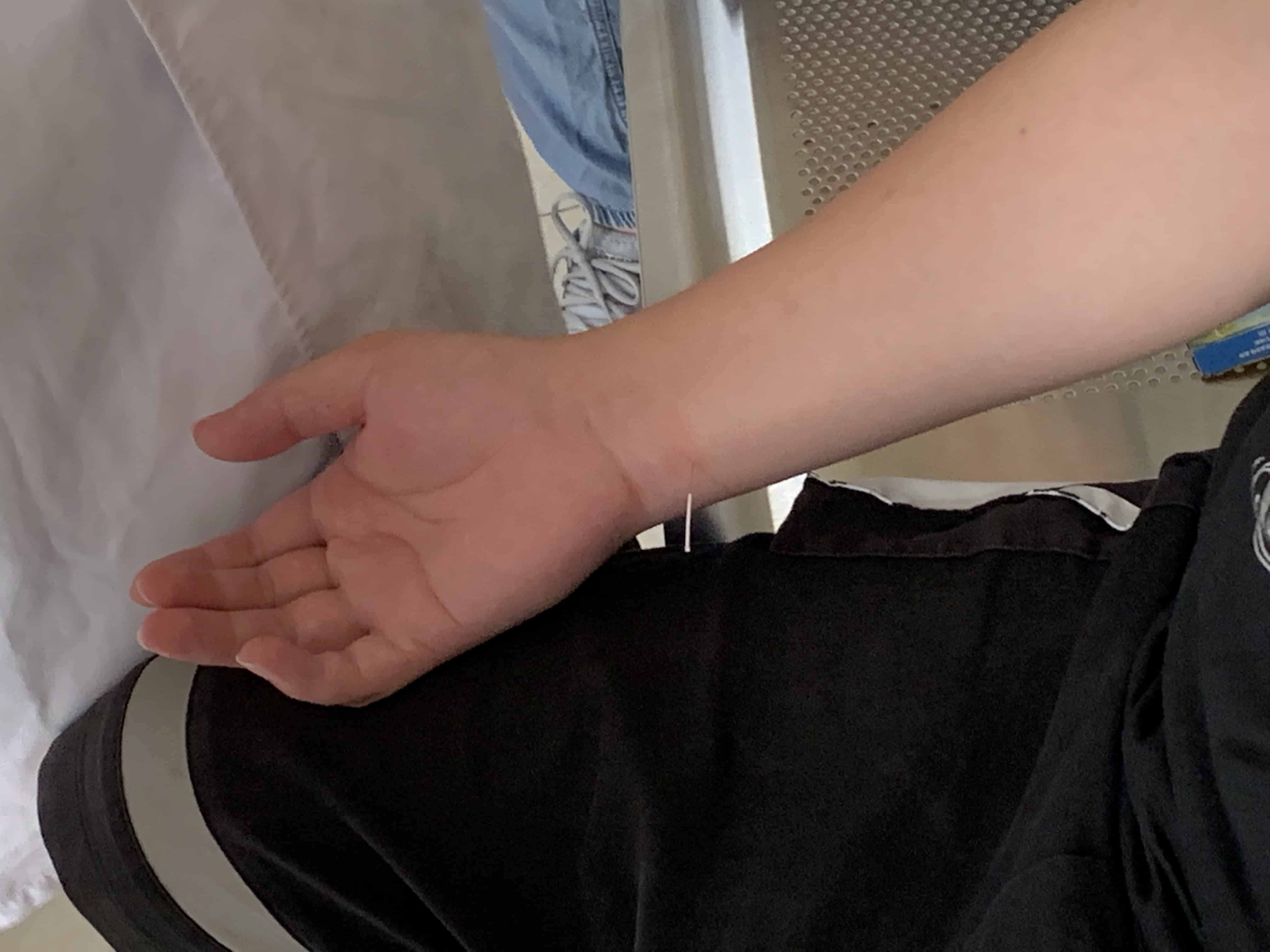 The Benefits of Using Acupuncture to Treat Carpal Tunnel Syndrome Dr