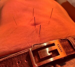 Patient receiving Acupuncture for Digestive Issues