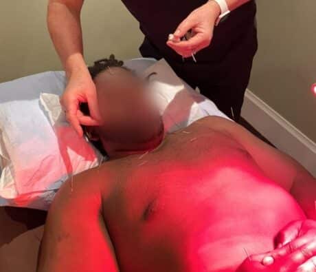 Dr. Tony Willcox placing acupuncture needles near a patient's temple, with needles along the chest and arms, at Acupuncture Zen in Delray Beach