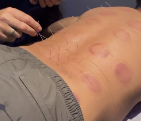 Acupuncture needles along the lower and middle back with cupping marks, part of TCM for back pain at Acupuncture Zen in Delray Beach