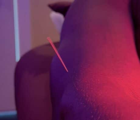 Acupuncture needle at the outer elbow during tennis elbow treatment under red light therapy
