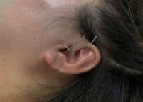 Ear Acupuncture for Cancer Care