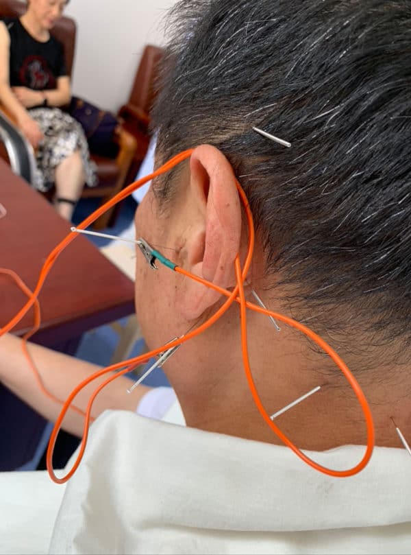 Electroacupuncture for chronic stroke