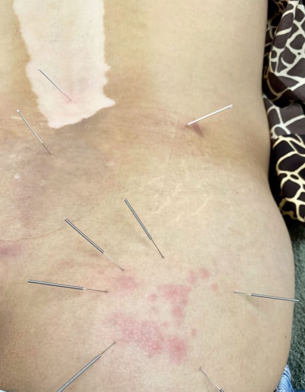 Acupuncture treatment for Skin Disorders