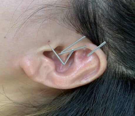 Ear acupuncture for anxiety: fine acupuncture needles placed at calming points on the outer ear at Acupuncture Zen in Delray Beach