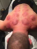 Marks from cupping can be used diagnostically in relation to dysfunction of Qi & Blood - a Chinese Medicine concept