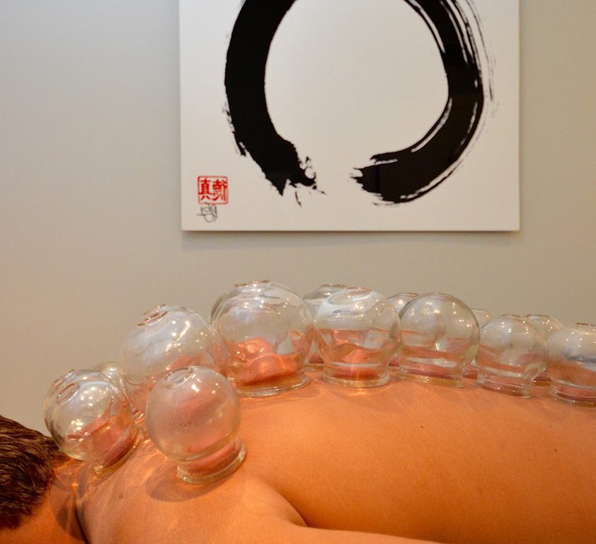 Cupping