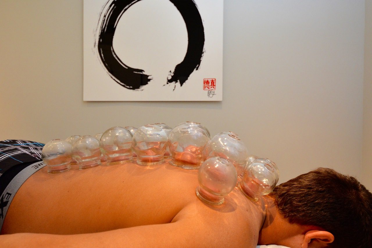 Cupping Therapy with Acupuncture