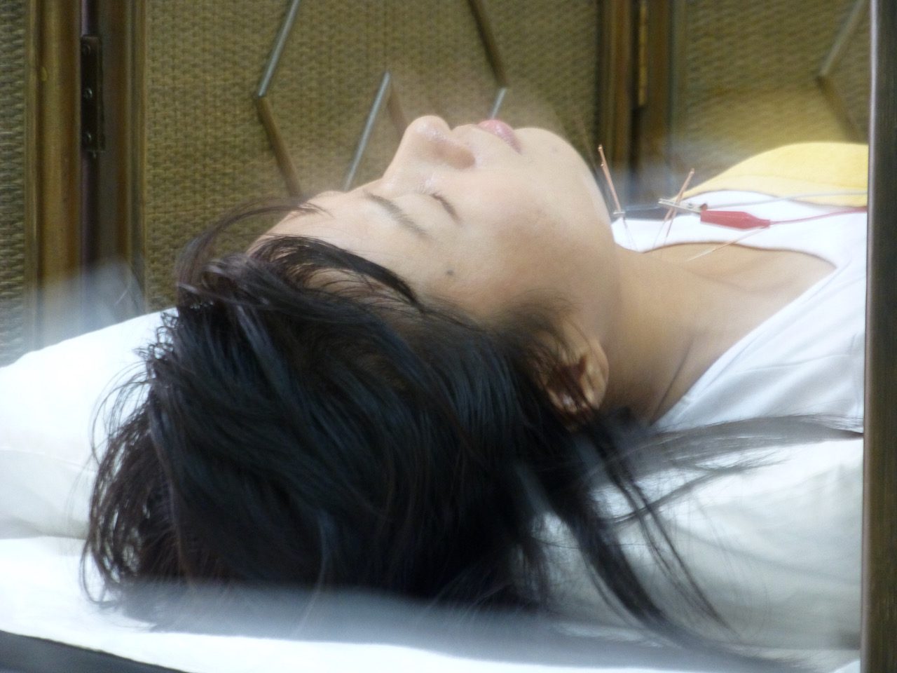 Acupuncture and Qi Acupuncture Zen in Delray with Dr. Tony