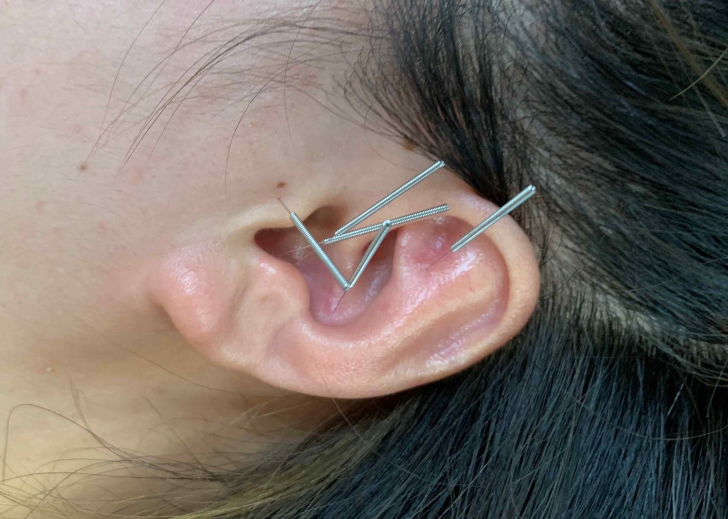 Tinnitus Treatment Specialist Dr. Tony Willcox D.O.M., A.P.