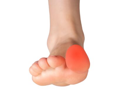 Turf Toe Healing Delray Beach: Acupuncture, K Laser & Red Light