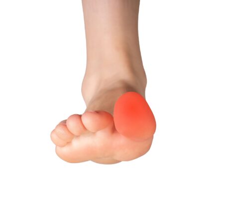 Turf Toe Healing Delray Beach: Acupuncture, K Laser & Red Light