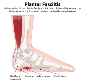 Plantar fasciitis anatomy showing inflammation of the plantar fascia near the heel