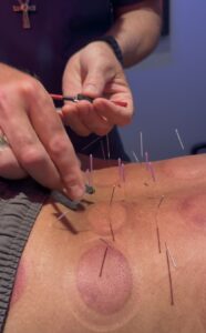 Close up of Dr. Tony Willcox attaching electro-acupuncture microcurrent clips to acupuncture needles on a patient's back with cupping marks visible at Acupuncture Zen Delray Beach FL