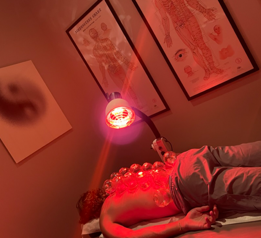 Patient receiving cupping therapy with infrared heat lamp on back at Acupuncture Zen in Delray Beach, Florida — traditional Chinese medicine treatment for pain relief and muscle recovery