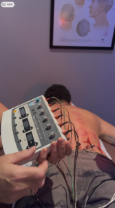 Dr. Tony Willcox operating the ITO ES-160 electro-acupuncture device with microcurrent cables connected to acupuncture needles on a patient's back at Acupuncture Zen in Delray Beach FL
