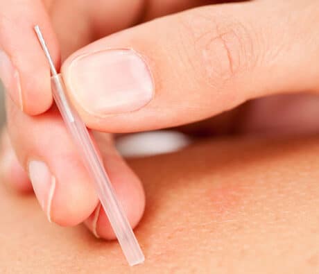 Acupuncture needle used in overactive bladder treatment