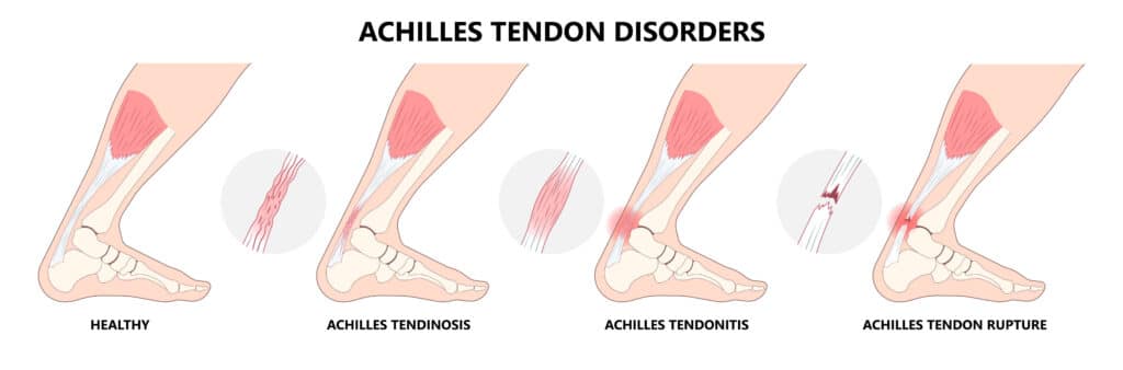Diagram comparing a healthy Achilles tendon with Achilles tendinosis, tendonitis, and tendon rupture