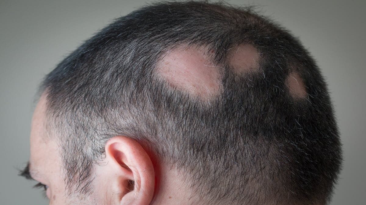 Back of a person's head showing patchy hair loss from alopecia areata
