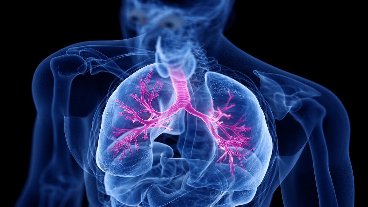 Medical illustration of the lungs and bronchial airways highlighted in the chest, representing bronchitis