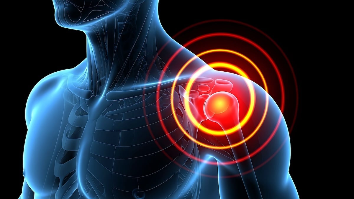Medical illustration of a shoulder joint highlighted in red, representing inflammation and pain from bursitis