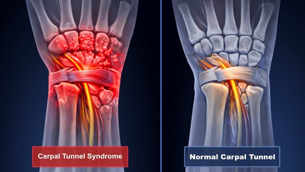 Medical illustration comparing a wrist with carpal tunnel syndrome to a normal carpal tunnel