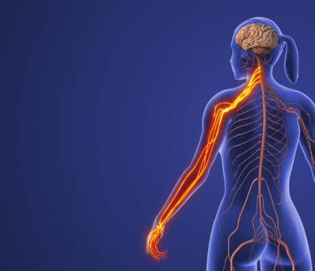 Nervous system illustration showing nerve pain radiating down the arm from cervical spinal stenosis