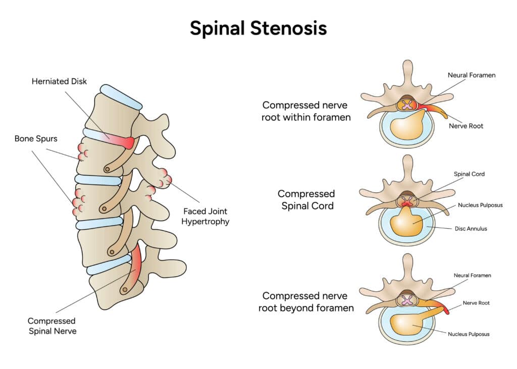 Diagram of spinal stenosis showing bone spurs, herniated disc, and compressed nerve root and spinal cord