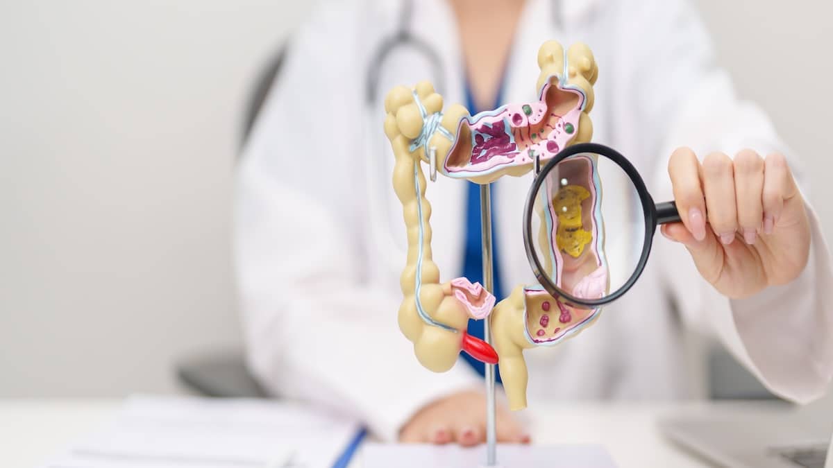 Doctor examining an anatomical model of the intestines with a magnifying glass, representing Crohn's disease