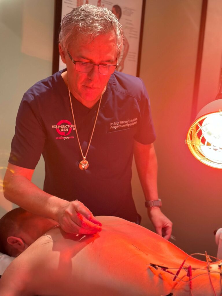 Dr. Tony Willcox, A.P., performing acupuncture with electro-stimulation under an infrared heat lamp at Acupuncture Zen in Delray Beach