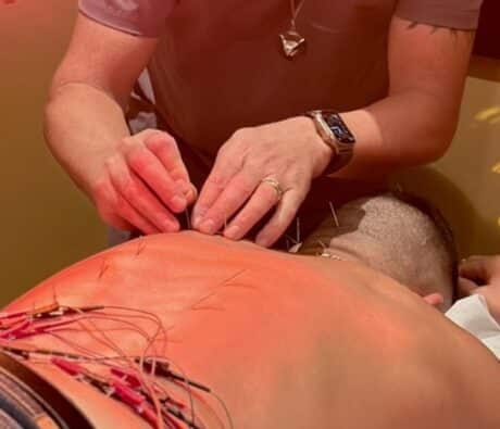 Acupuncture vs Dry Needling: What’s the Difference?
