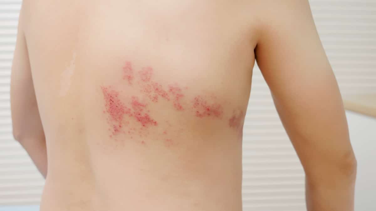 Herpes zoster (shingles) rash across the back — shingles care at Acupuncture Zen in Delray Beach