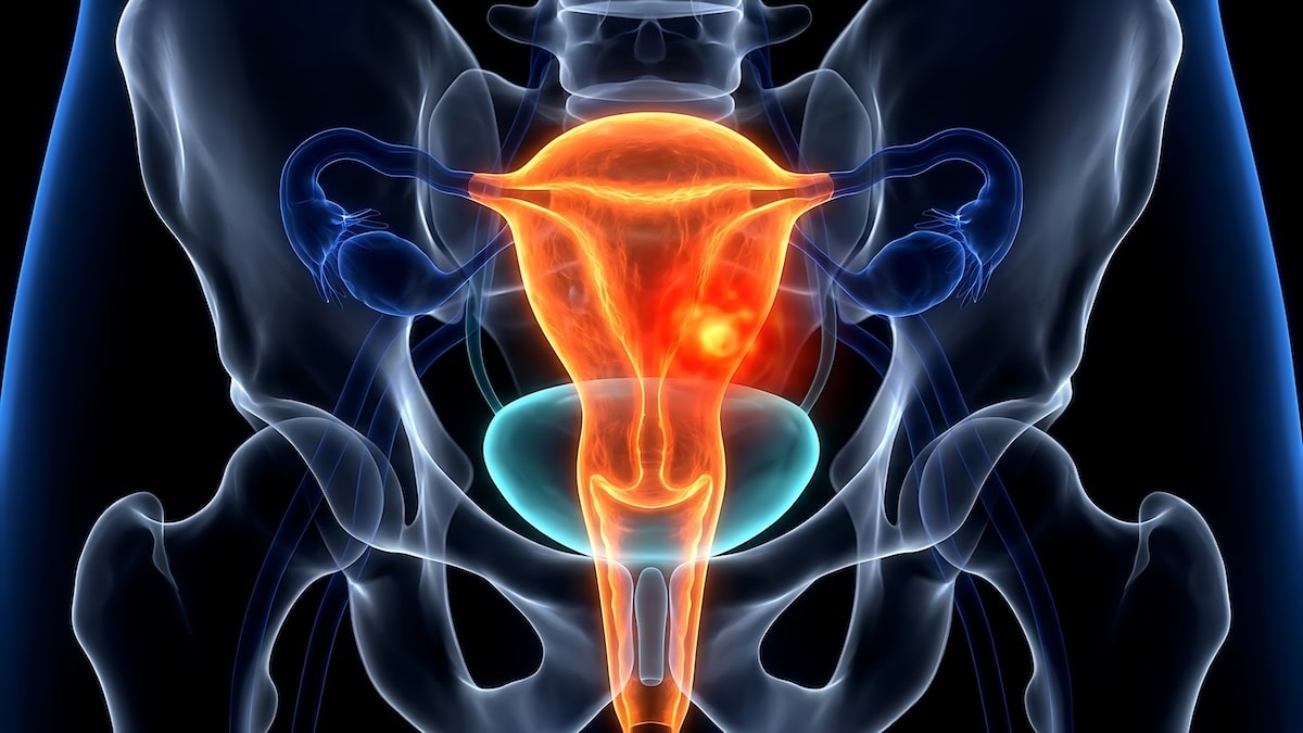 Digital illustration of the female reproductive system and pelvis with the uterus glowing orange, reproductive conditions acupuncture in Delray Beach