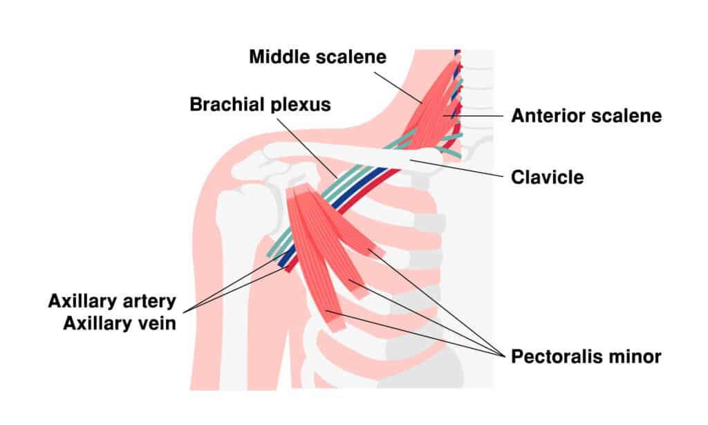 Thoracic outlet syndrome anatomy: scalene and pectoralis minor muscles near the brachial plexus, clavicle, and axillary vessels
