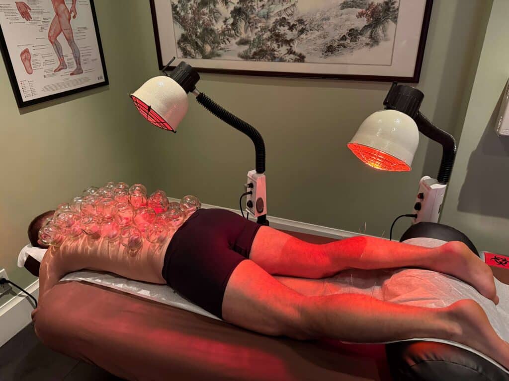 Active patient receiving acupuncture, cupping, and infrared therapy for muscle recovery at Acupuncture Zen in Delray Beach