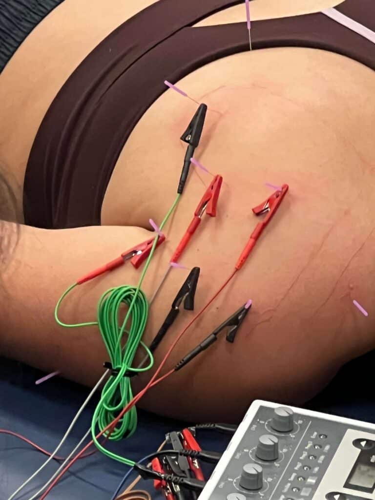 Close-up of electro-acupuncture needles with microcurrent leads, delivering frequency through the points.