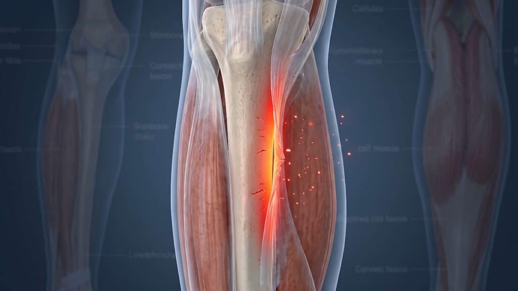 Anatomical illustration of the lower leg showing the tibia and calf muscles with inflammation along the shinbone in medial tibial stress syndrome.