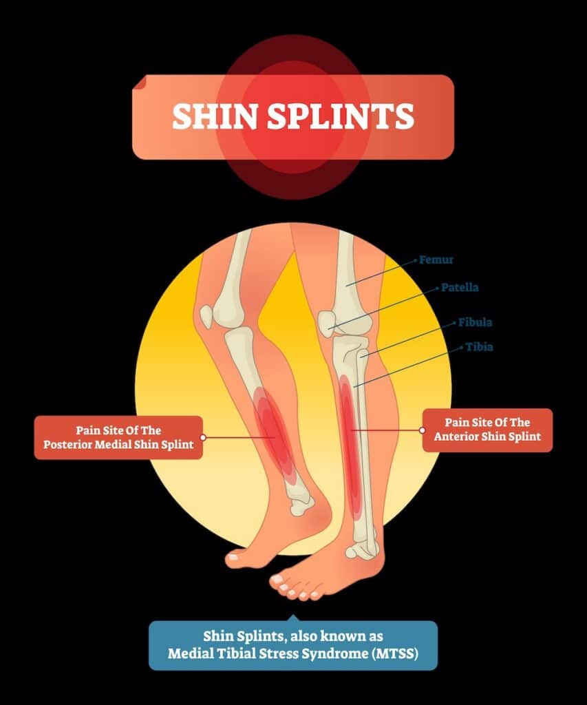 Shin splints diagram showing anterior and posterior medial pain sites along the tibia, also known as medial tibial stress syndrome.