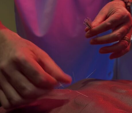 Using Your HSA and FSA for Acupuncture